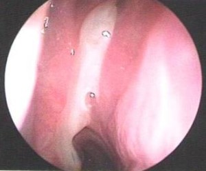 Sinusitis Aguda Imagen Endoscópica (Pus Saliendo de Seno Paranasal Hacia Nariz)