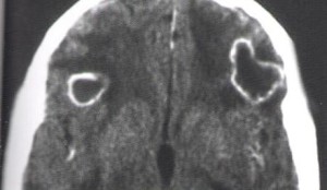 Sinusitis Frontal Complicada Con Abscesos Cerebrales RMN