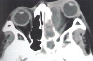 Sinusitis Frontal Complicada Con Absceso Subperióstico TAC