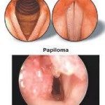 Papilomatosis Laringea