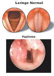 Papilomatosis Laringea