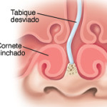 Tabique Nasal Desviado