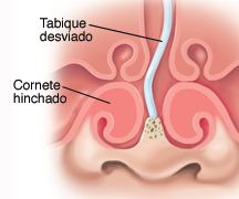 Tabique Nasal Desviado